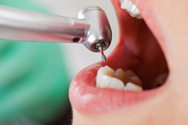 Best Emergency Root Canal Treatment in Rosedale, CA